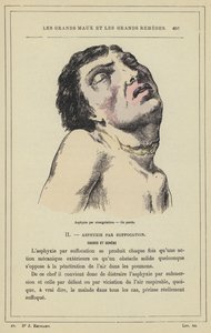 Asfixia por estrangulación, un ahorcado