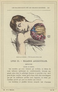 Asfixia por sumersión, Estado de los pulmones en un ahogado