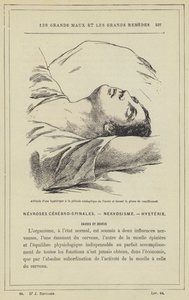 Actitud de una histérica en el período cataléptico del acceso y durante la fase de crucifixión de French School