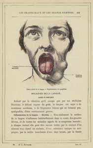Cáncer ulcerado de la lengua, Degeneración de los ganglios de French School