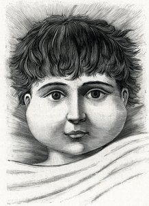 Niño con paperas (grabado) 1888 de French School