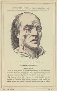 Eclosión de larvas de moscas en las cavidades y bajo la piel del rostro