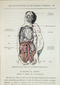 Efectos de la diabetes, de 