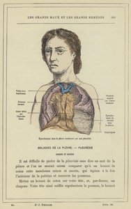 Derrame en la pleura ocasionado por una pleuresía de French School