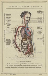 Figura ideal, mostrando el curso de un virus en el cuerpo y los accidentes sucesivos de una diátesis de evolución completa, según la teoría del autor de French School