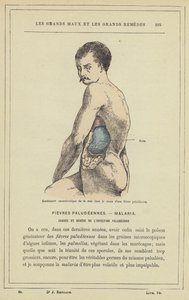 Hinchazón característica del bazo durante una fiebre palúdica de French School