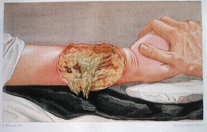 Gangrena hospitalaria, de 