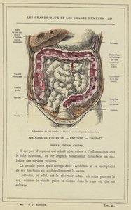 Inflamación del intestino grueso, Lesiones características de la disentería de French School