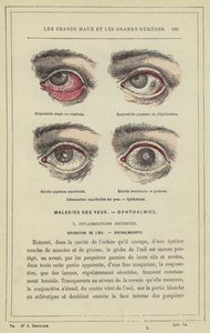 Inflamaciones superficiales de los ojos, Oftalmías de French School