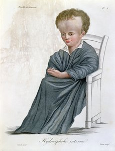 Hidrocefalia interna, de Nosologie Naturelle por Baron Jean Louis Alibert (1768-1837) grabado por Tresca, 1817 de French School