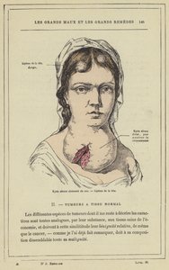 Quiste seroso tabicado del cuello, Lipoma de la cabeza