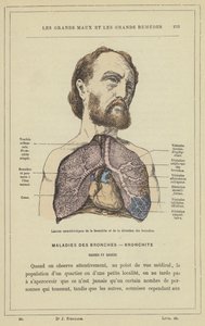 Lesiones características de la bronquitis y la dilatación de los bronquios de French School