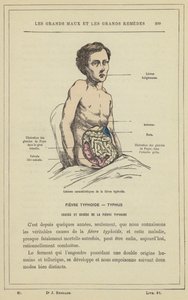 Lesiones características de la fiebre tifoidea de French School