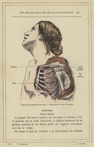 Luxación subcoracoidea del hombro, desplazamiento de la cabeza del húmero de French School