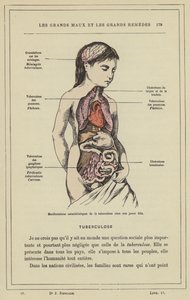 Manifestaciones características de la tuberculosis en una joven de French School