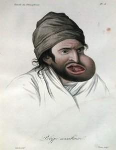 Pólipo maxilar, de un libro de Baron Jean Louis Alibert (1768-1837) 1817