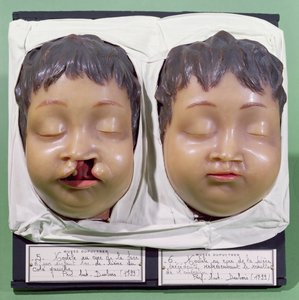 Modelo que muestra el rostro de un niño antes y después de una operación para corregir un labio leporino realizada por Antoine Dubois (1756-1837) en 1799