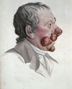 Micosis Fongoide, de un libro de Baron Jean Louis Alibert (1768-1837) 1838
