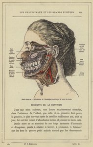 Nervios dentales, Mecanismo del dolor dental producido por la caries de French School