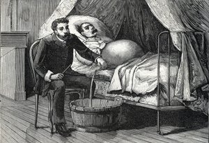 Paciente con cirrosis hepática avanzada, doctor realizando una punción (grabado) 1888 de French School
