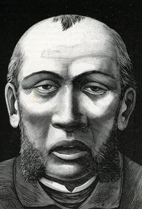 Paciente con reblandecimiento cerebral (grabado) 1888 de French School