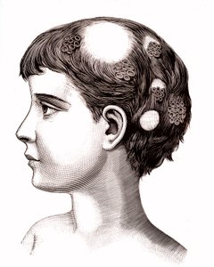 Tiña en un niño. 1887 (grabado) de French School