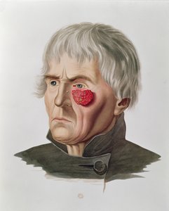 Enfermedad de la piel antes de una operación, de Selecta Praxis Medico-Chirurgica por Alexander Auvert, París, 1856