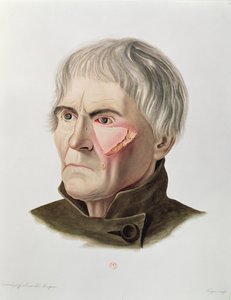 Operación de injerto de piel, de Selecta Praxis Medico-Chirurgica por Alexander Auvert, París, 1856