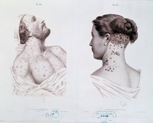 Síntomas de sífilis en hombres y mujeres, de un libro médico, c.1850-60 de French School