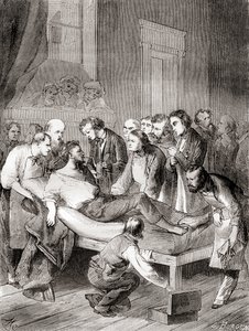 La primera demostración pública del uso de éter inhalado como anestésico quirúrgico en 1846 por un dentista estadounidense, William Thomas Green Morton, de 