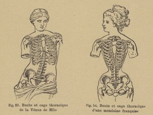 Comparación de la forma del pecho y la caja torácica de la Venus de Milo con la de una socialité francesa de finales del siglo XIX