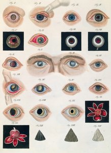 Descripción de anomalías congénitas del ojo, de Klinische Darstellungen der Krankheiten und Blidungsfehler des Menschlichen Auges, por Friedrich August von Ammon (1799-1861) 1838