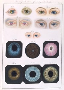 Descripción de anomalías congénitas del ojo, de Klinische Darstellungen der Krankheiten und Blidungsfehler des Menschlichen Auges, por Friedrich August von Ammon (1799-1861) 1838 de German School