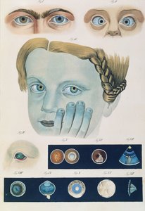 Descripción de anomalías congénitas del ojo, de Klinische Darstellungen der Krankheiten und Blidungsfehler des Menschlichen Auges, por Friedrich August von Ammon (1799-1861) 1838