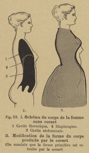 Diagrama que muestra el efecto de usar un corsé en la forma del cuerpo de una mujer