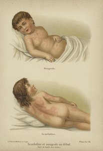 Síntomas tempranos del sarampión y la escarlatina de German School