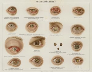 Trastornos oculares de German School