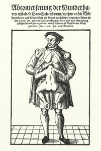 Hans Kaltenbrunn y su gemelo unido no desarrollado de German School
