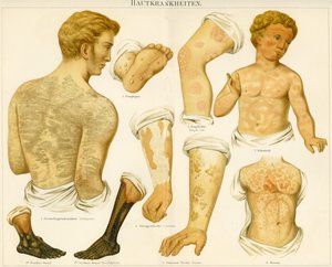 Trastornos de la piel, c.1890 de German School