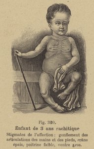 Niño de tres años con raquitismo de German School