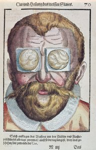 Tratamiento de una afección ocular, de Ophthalmodouleia por Georg Bartisch (1535-1636) publicado en Dresde en 1583