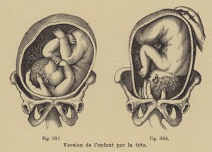 Girando a un bebé en el útero de su madre para que la cabeza esté hacia abajo antes del nacimiento de German School