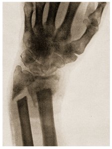 Radiografía de una muñeca fracturada c.1890
