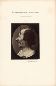 Electrofisiología fotográfica, Figura 39 de Guillaume Benjamin Duchenne