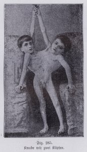 Giacomo y Giovanni Battista Tocci, gemelos siameses italianos