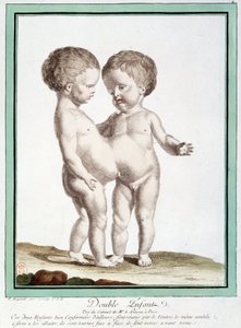 Niños siameses - en “Las desviaciones de la naturaleza” por Régnault