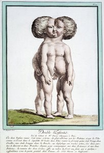 Niños siameses - en “Las desviaciones de la naturaleza” por Régnault de Jean Baptiste Regnault