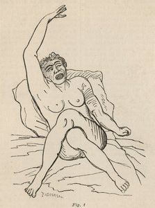 Epilepsia histérica, ataque, contorsiones, fig. 1 de 