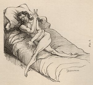 Epilepsia histérica, ataque, contorsiones, fig. 3 de 