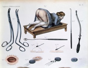 Operación de una fístula vesicovaginal, lámina de 